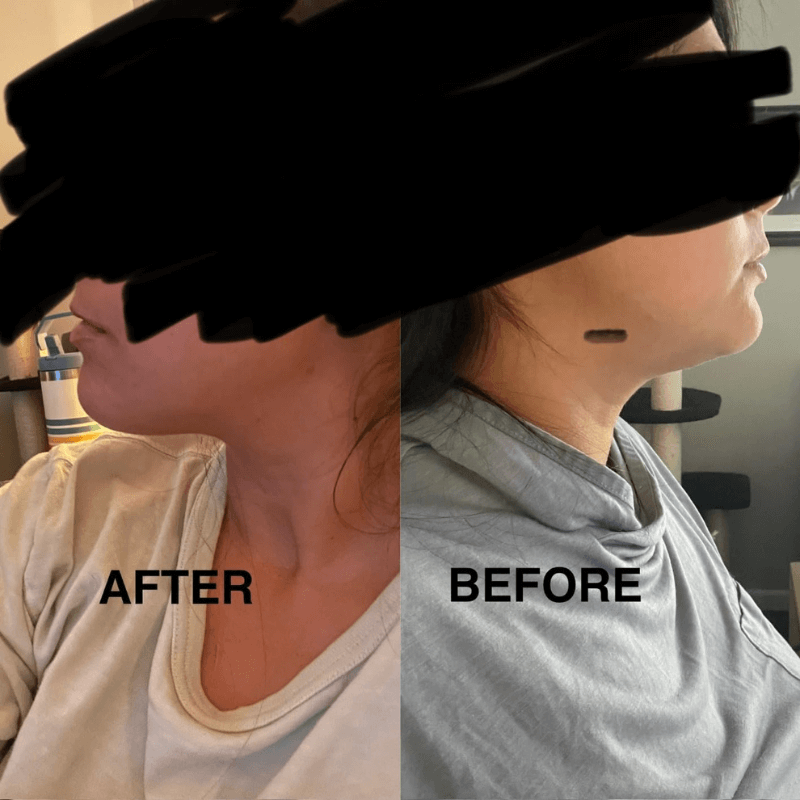 DermaLift - LED Neck & Face Sculpting Device